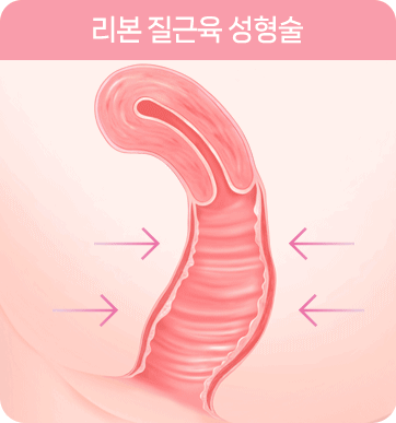 질 점막 돌기 성형술 : Vaginal mucosal ridge correction: vaginal tightening surgery