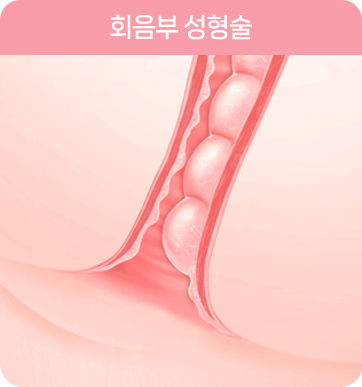 회음부 성형술 Perineoplasty